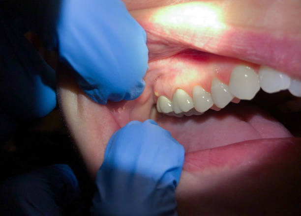 Best Emergency Treatment for Dental Infections or Abscesses in Van Alstyne, TX